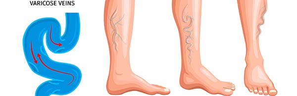 Varicose Veins